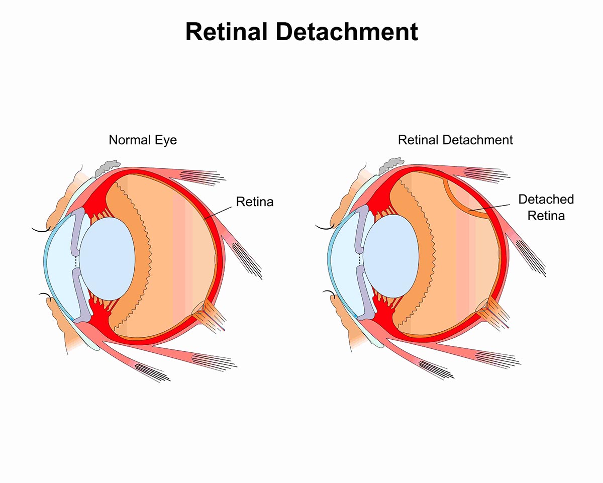 Retinal Detachment Treatment In Chicago IL Kraff Eye Institute retinal-detachment-treatment-in-chicago-il-kraff-eye-institute